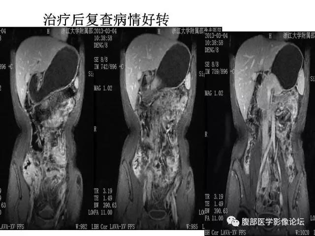 【PPT】磁共振成像小肠造影
