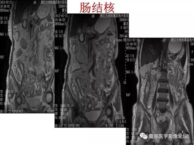 【PPT】磁共振成像小肠造影