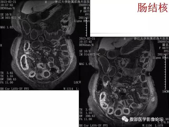 【PPT】磁共振成像小肠造影