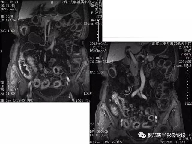 【PPT】磁共振成像小肠造影