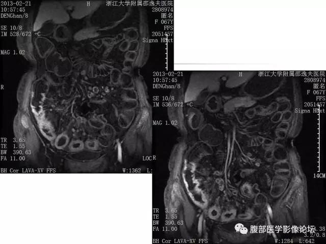 【PPT】磁共振成像小肠造影