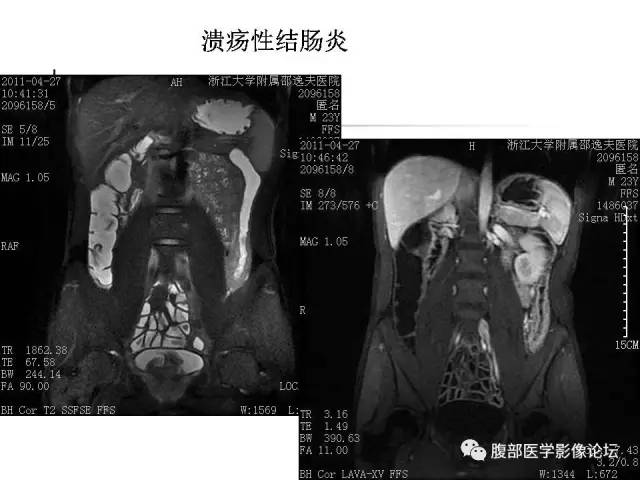 【PPT】磁共振成像小肠造影