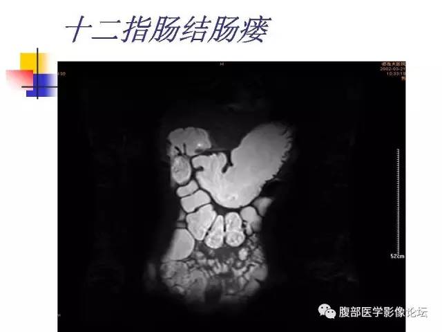 【PPT】磁共振成像小肠造影
