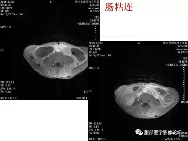 【PPT】磁共振成像小肠造影