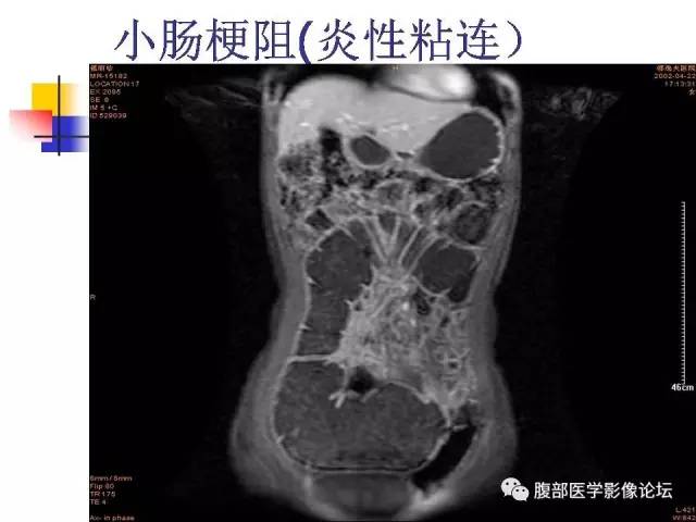【PPT】磁共振成像小肠造影