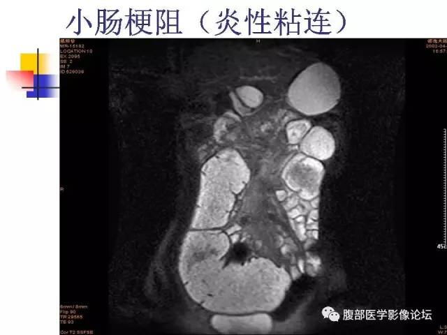 【PPT】磁共振成像小肠造影