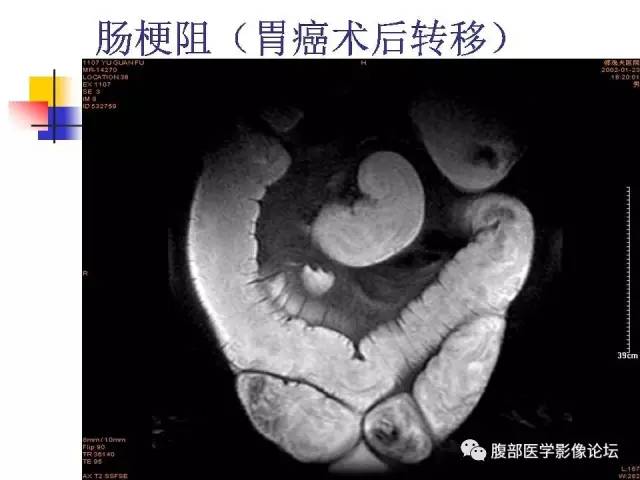 【PPT】磁共振成像小肠造影