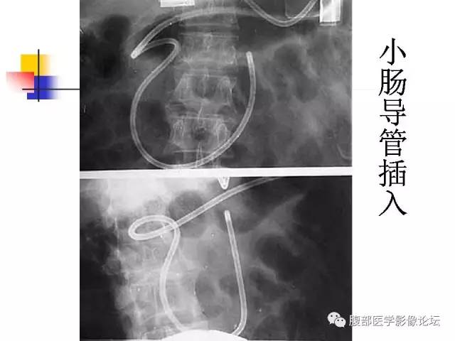 【PPT】磁共振成像小肠造影