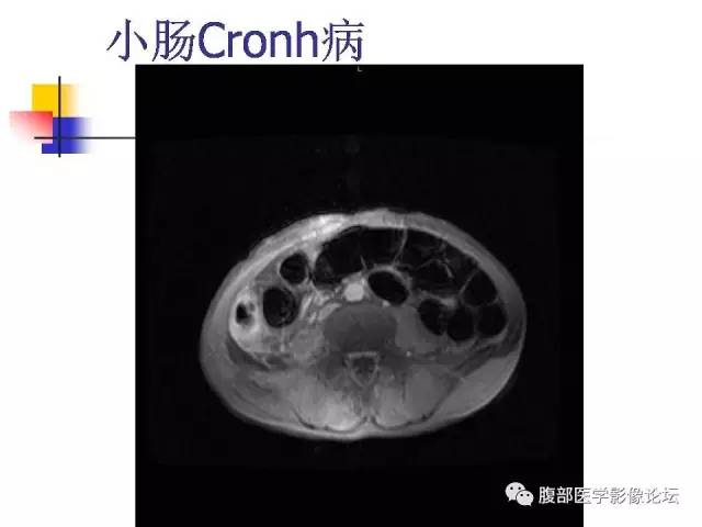 【PPT】磁共振成像小肠造影