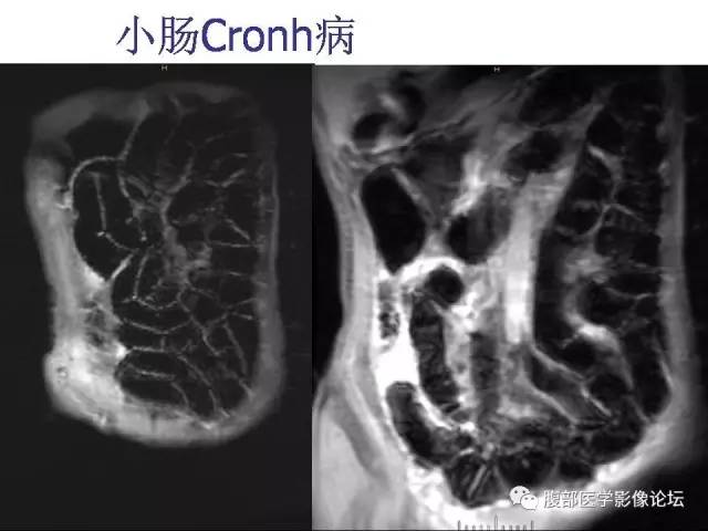 【PPT】磁共振成像小肠造影