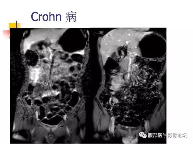 【PPT】磁共振成像小肠造影