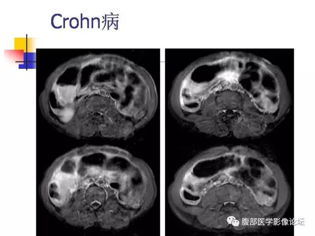 【PPT】磁共振成像小肠造影