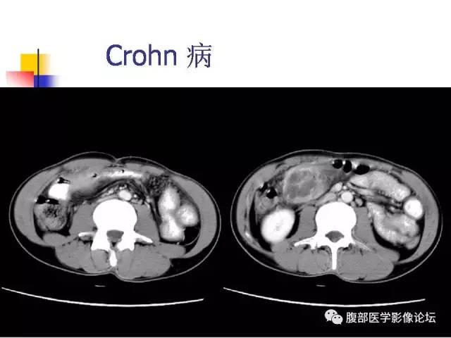【PPT】磁共振成像小肠造影