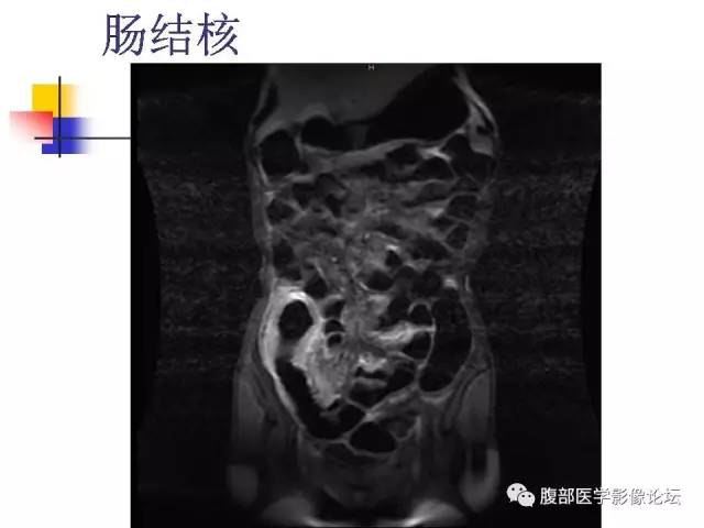 【PPT】磁共振成像小肠造影