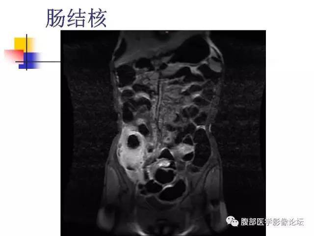 【PPT】磁共振成像小肠造影