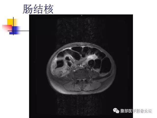 【PPT】磁共振成像小肠造影