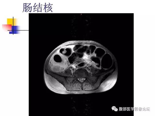 【PPT】磁共振成像小肠造影