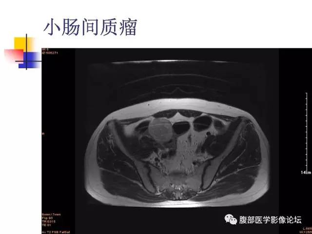 【PPT】磁共振成像小肠造影