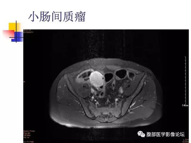 【PPT】磁共振成像小肠造影