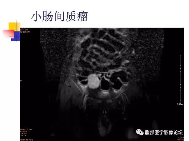 【PPT】磁共振成像小肠造影