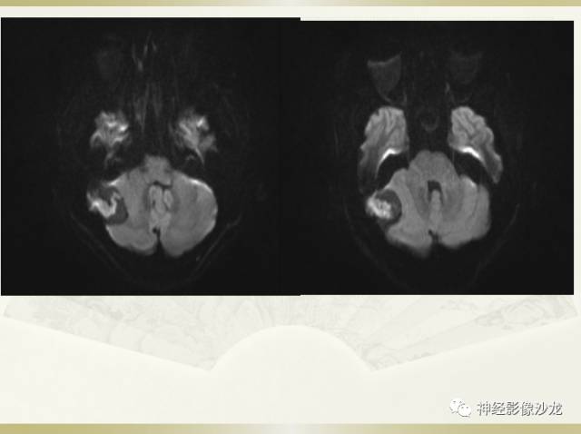 【病例】右枕部表皮样囊肿1例CT影像表现