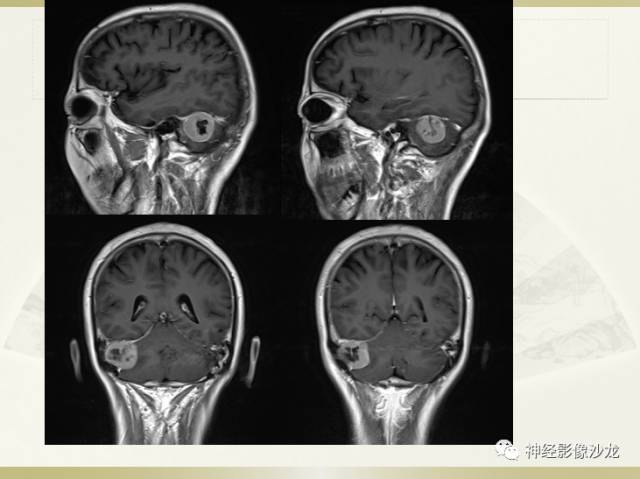 【病例】右枕部表皮样囊肿1例CT影像表现