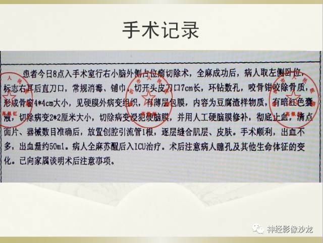 【病例】右枕部表皮样囊肿1例CT影像表现