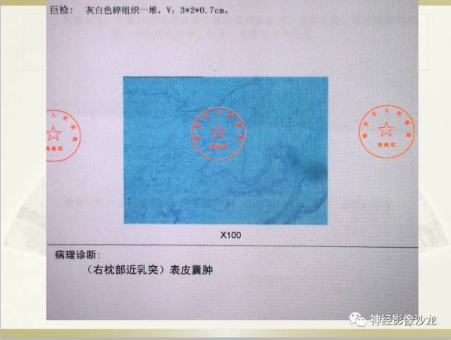 【病例】右枕部表皮样囊肿1例CT影像表现