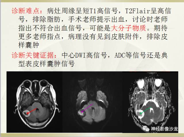 【病例】右枕部表皮样囊肿1例CT影像表现