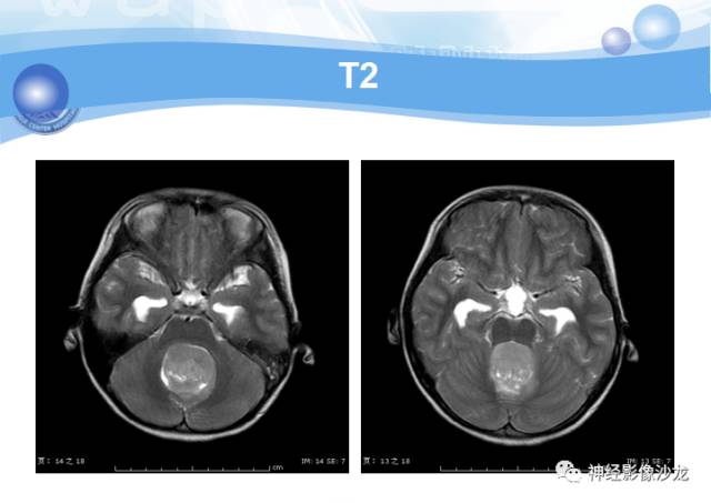 【病例】髓母细胞瘤一例MR影像表现