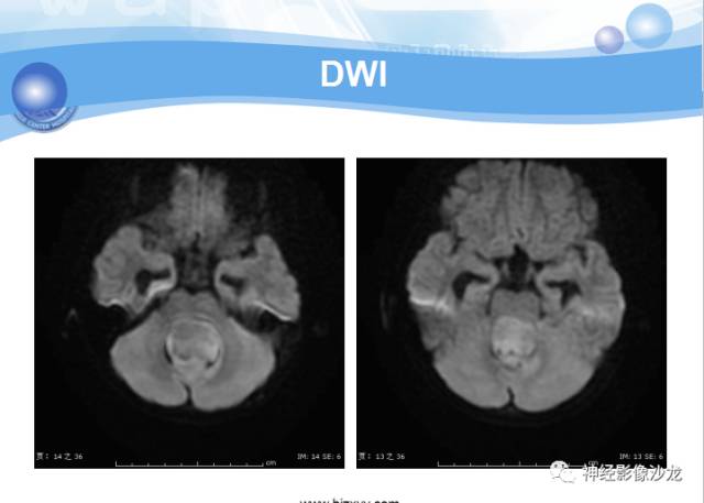 【病例】髓母细胞瘤一例MR影像表现