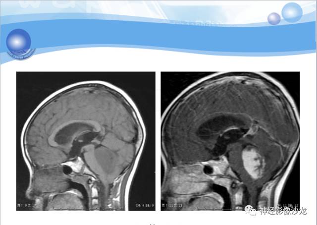 【病例】髓母细胞瘤一例MR影像表现