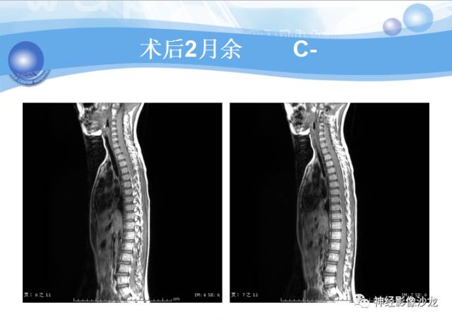 【病例】髓母细胞瘤一例MR影像表现