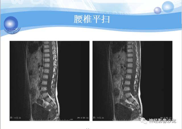 【病例】髓母细胞瘤一例MR影像表现