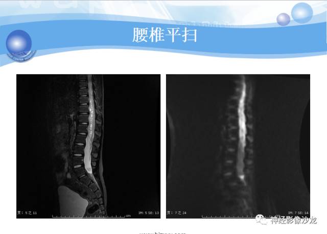 【病例】髓母细胞瘤一例MR影像表现