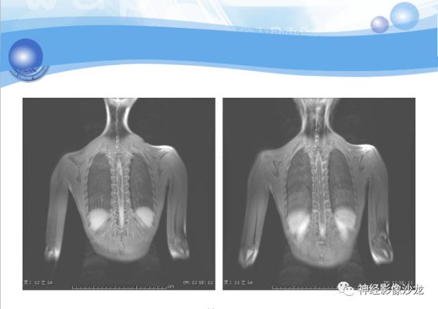【病例】髓母细胞瘤一例MR影像表现