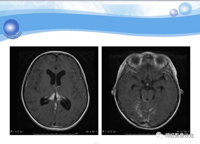 【病例】髓母细胞瘤一例MR影像表现