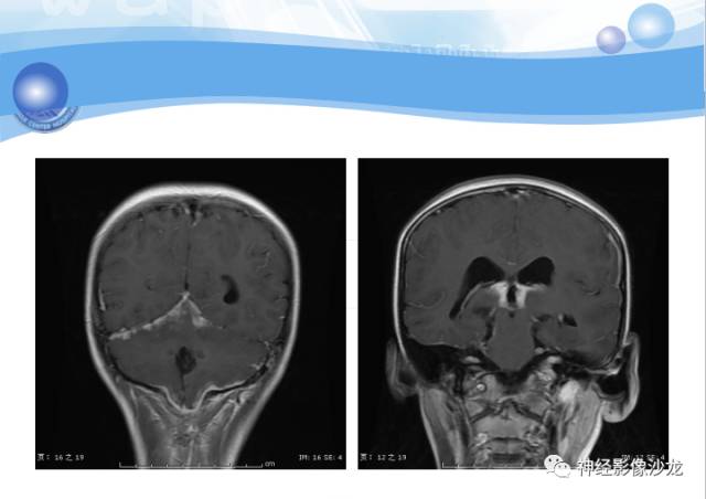 【病例】髓母细胞瘤一例MR影像表现