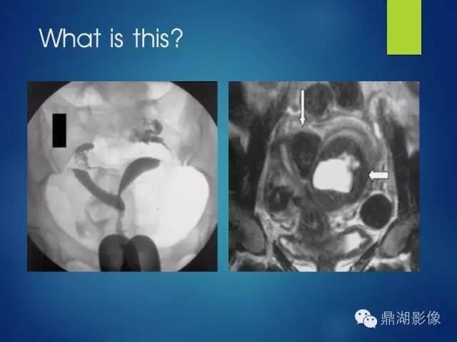 【PPT】苗勒氏管畸形的影像学诊断