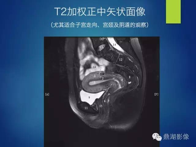 【PPT】苗勒氏管畸形的影像学诊断