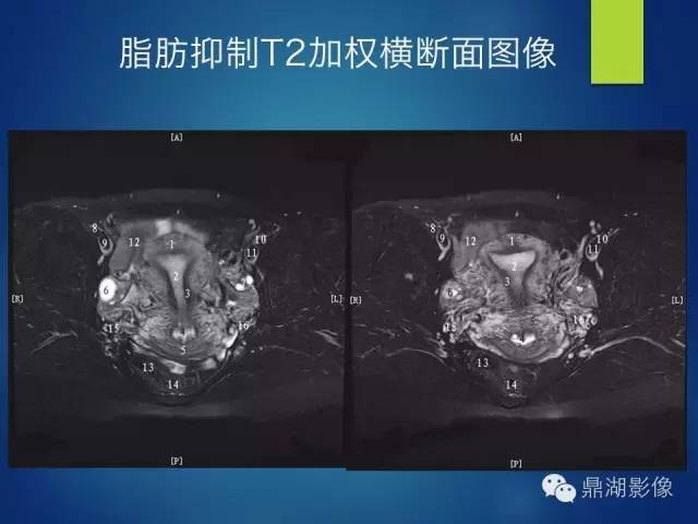 【PPT】苗勒氏管畸形的影像学诊断