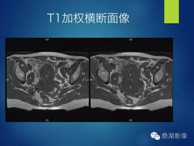【PPT】苗勒氏管畸形的影像学诊断