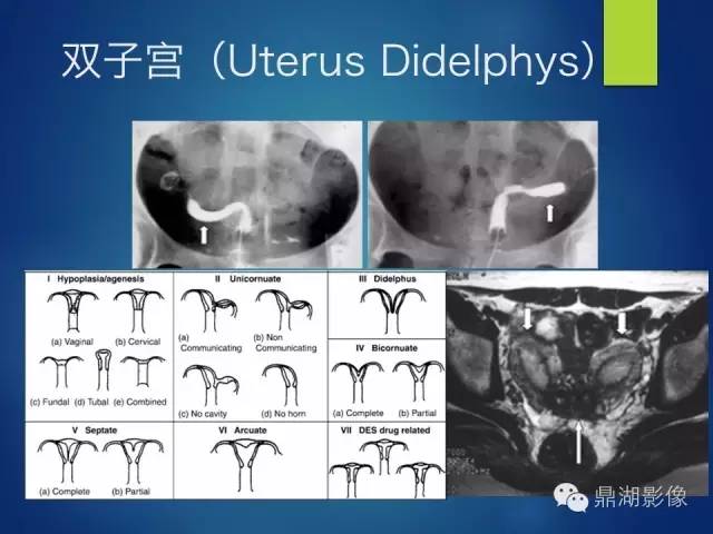 【PPT】苗勒氏管畸形的影像学诊断