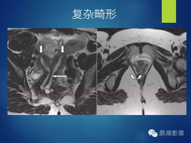 【PPT】苗勒氏管畸形的影像学诊断