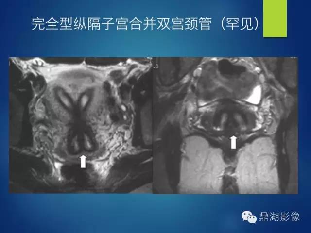 【PPT】苗勒氏管畸形的影像学诊断