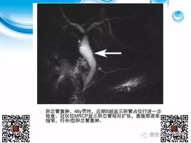【PPT】胆道狭窄和胆道肿块样病变