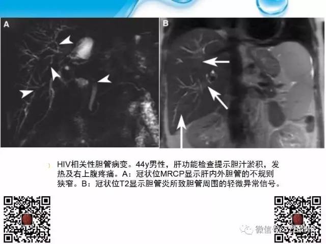 【PPT】胆道狭窄和胆道肿块样病变
