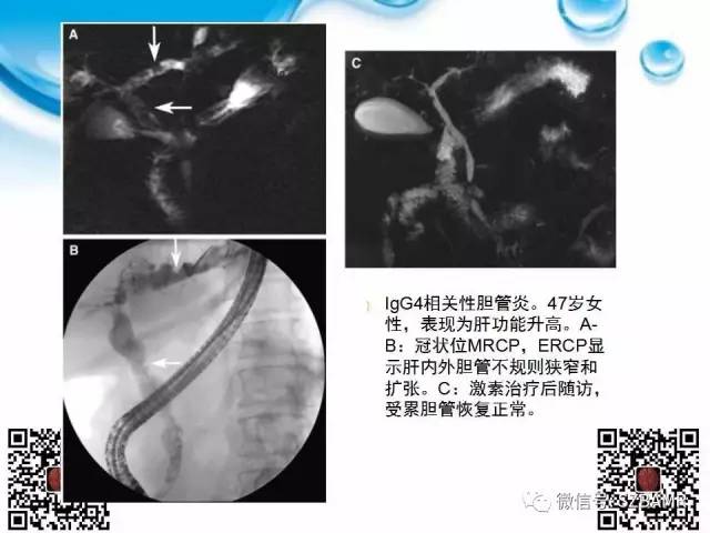 【PPT】胆道狭窄和胆道肿块样病变