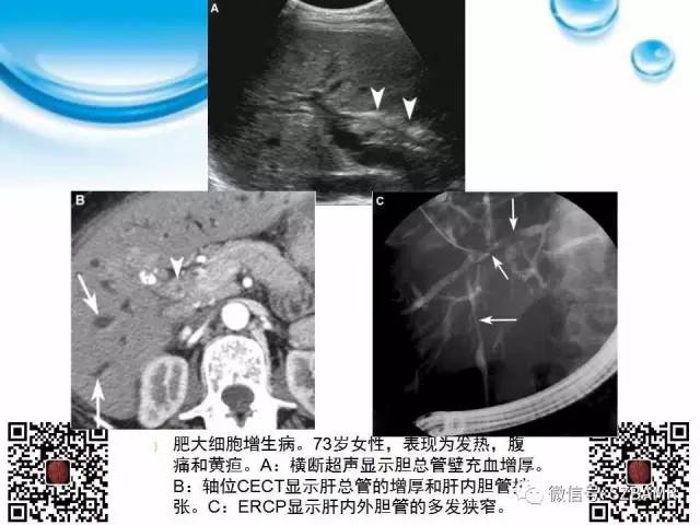 【PPT】胆道狭窄和胆道肿块样病变