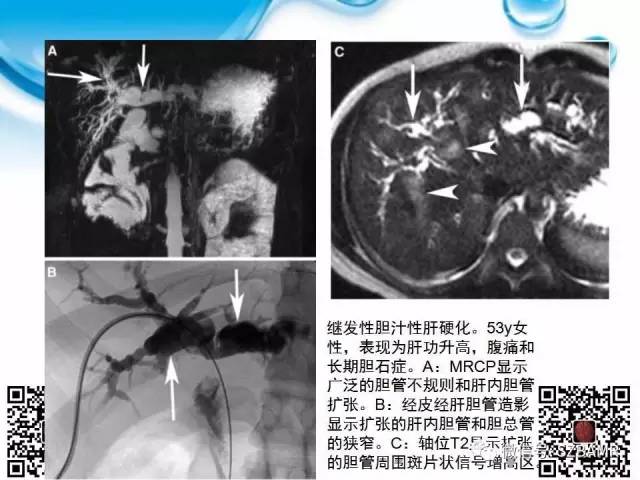 【PPT】胆道狭窄和胆道肿块样病变